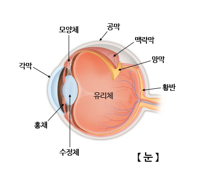 백내장