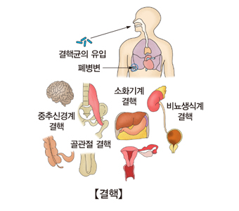 결핵이란?