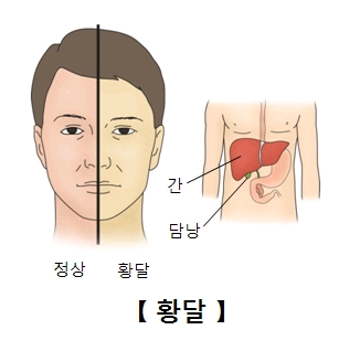 A형 간염이란?