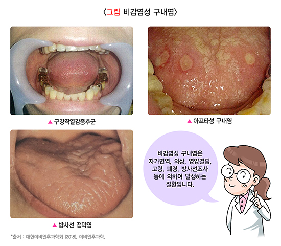 구내염이란?
- 구강 내 점막에서 발생하는 염증 질환의 통칭